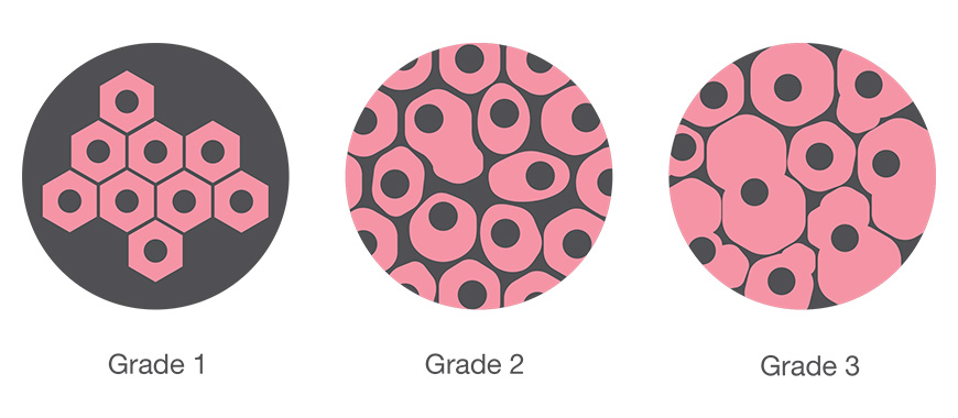 breast cancer grades and