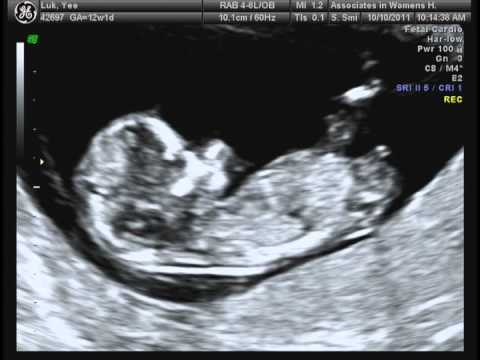 12 week ultrasound boy